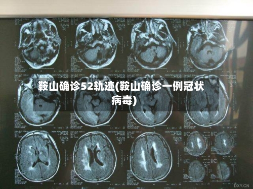 鞍山确诊52轨迹(鞍山确诊一例冠状病毒)