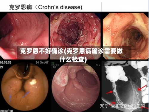 克罗恩不好确诊(克罗恩病确诊需要做什么检查)-第2张图片