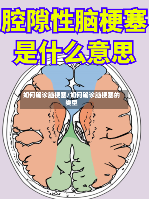 如何确诊脑梗塞/如何确诊脑梗塞的类型
