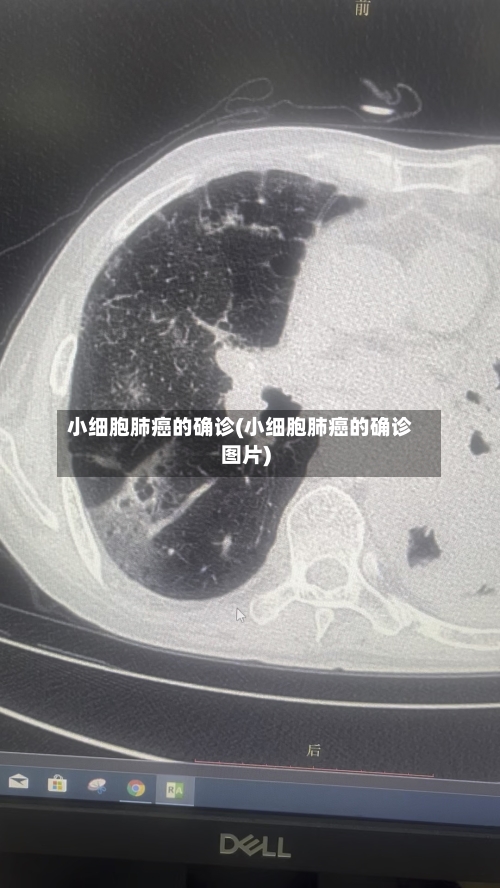 小细胞肺癌的确诊(小细胞肺癌的确诊图片)-第2张图片