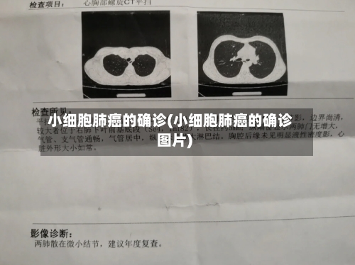 小细胞肺癌的确诊(小细胞肺癌的确诊图片)-第3张图片
