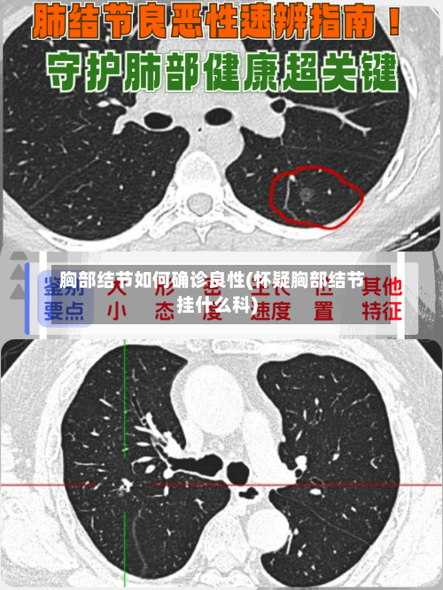 胸部结节如何确诊良性(怀疑胸部结节挂什么科)