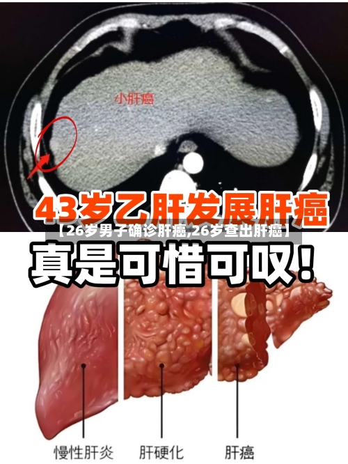 【26岁男子确诊肝癌,26岁查出肝癌】