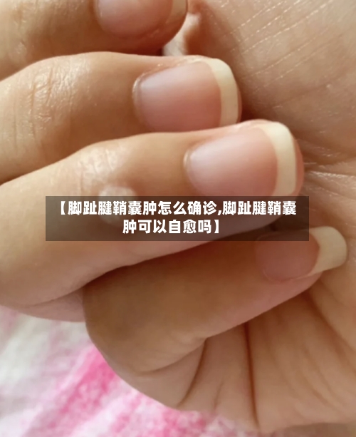 【脚趾腱鞘囊肿怎么确诊,脚趾腱鞘囊肿可以自愈吗】-第2张图片