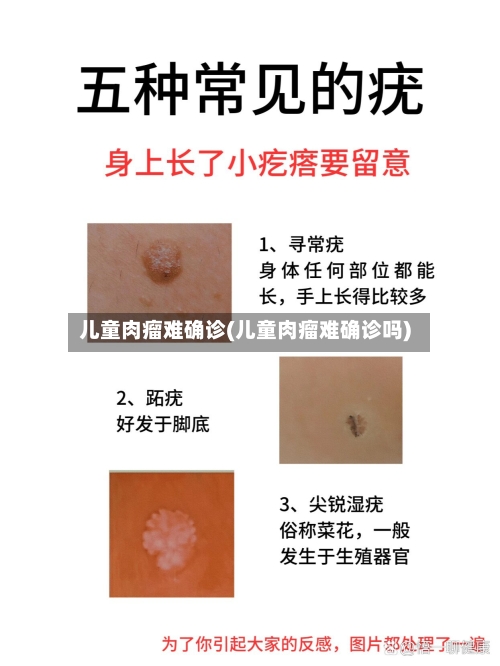 儿童肉瘤难确诊(儿童肉瘤难确诊吗)